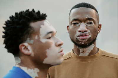 vitiligo-a-divatvilagban